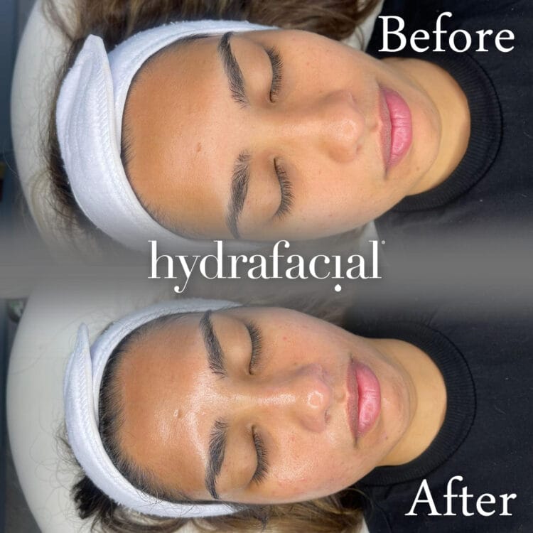HydraFacial Glowing Skin