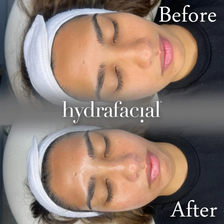 HydraFacial Glowing Skin HydraFacial Glowing Skin