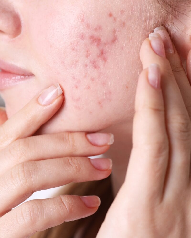 Microneedling for Acne Scars: How It Works and Why It’s Effective Microneedling for Acne Scars: How It Works and Why It’s Effective