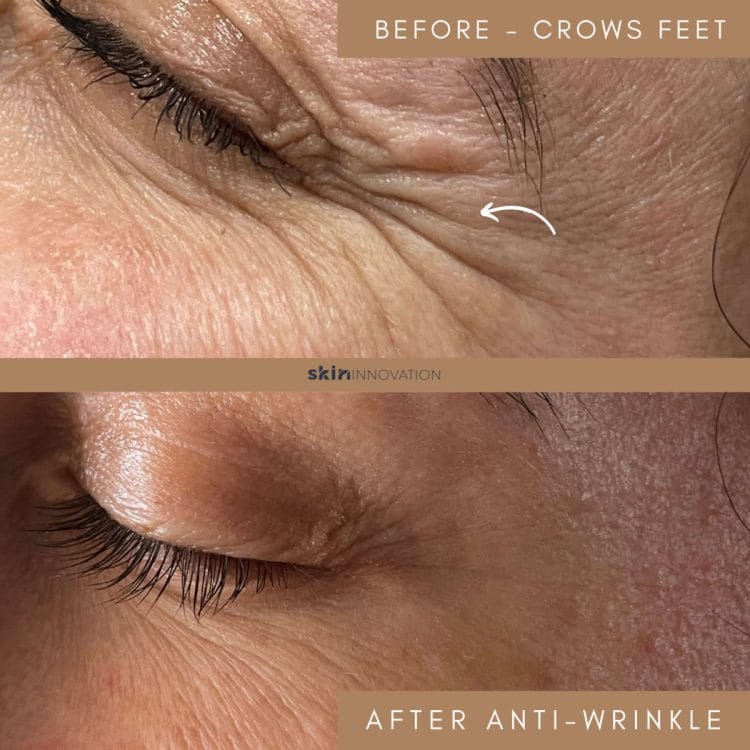 Anti Wrinkle Injections Anti Wrinkle Injections