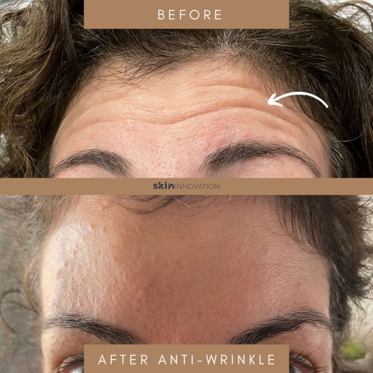 Anti Wrinkle Injections Anti Wrinkle Injections