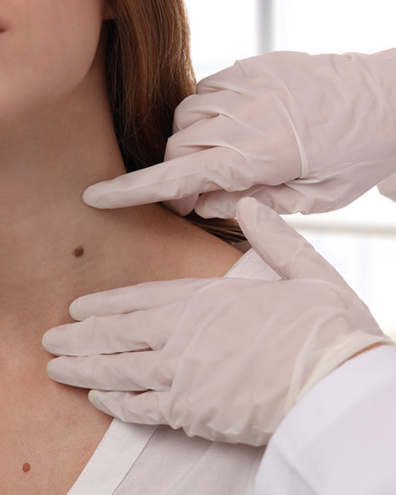 Is Freezing Warts Effective?