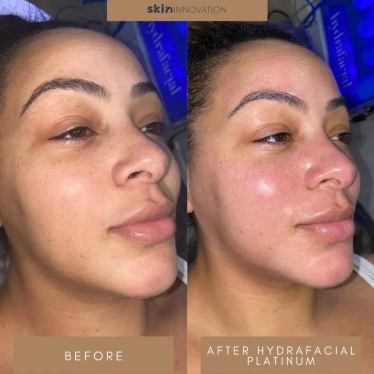 Hydrafacial Before and After 2 hydrafacial-before-and-after-2