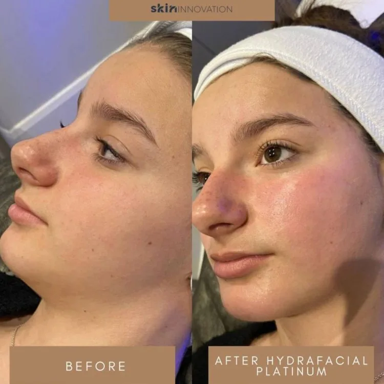 Hydrafacial Before and After 3 hydrafacial-before-and-after-3