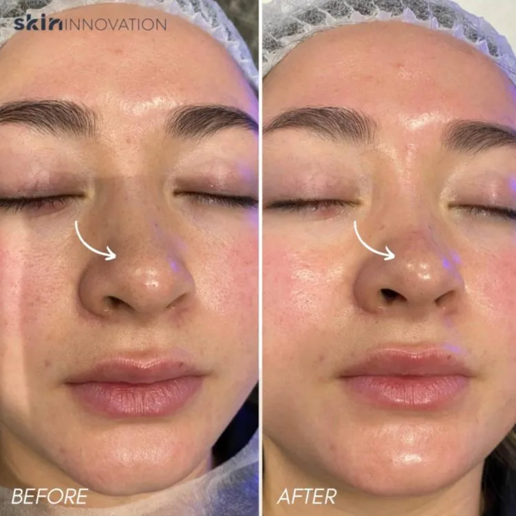Hydrafacial Before and After 1 hydrafacial-before-and-after-1
