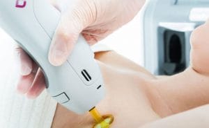 LASER HAIR REMOVAL 5