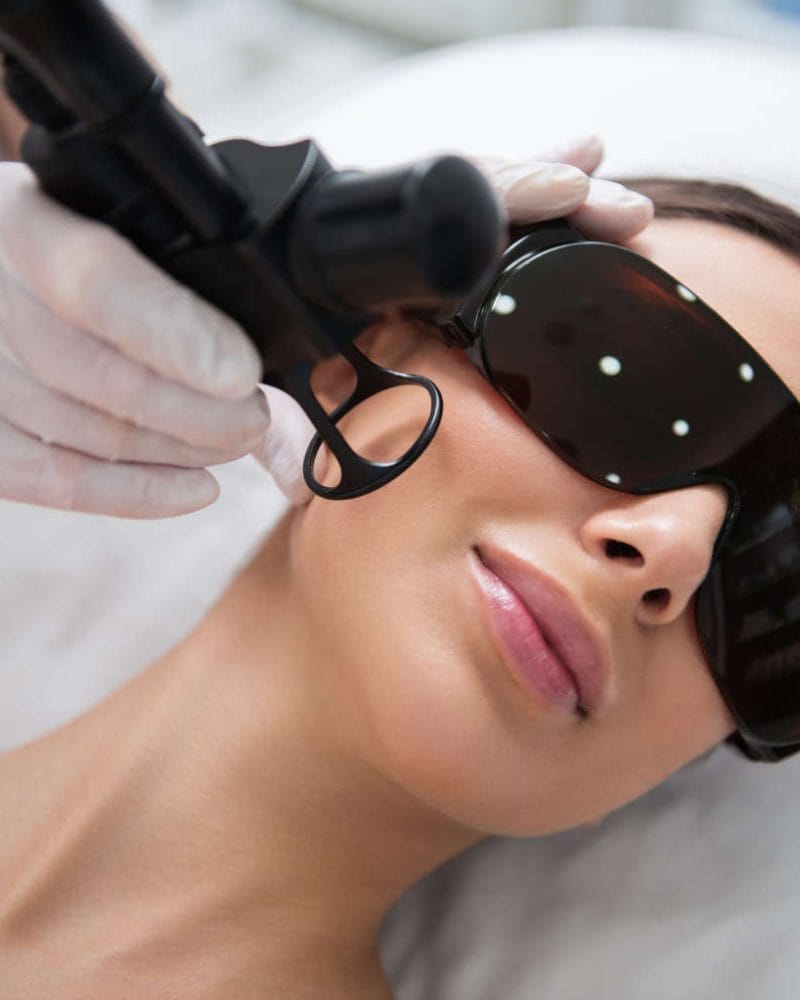 Laser Skin Tightening