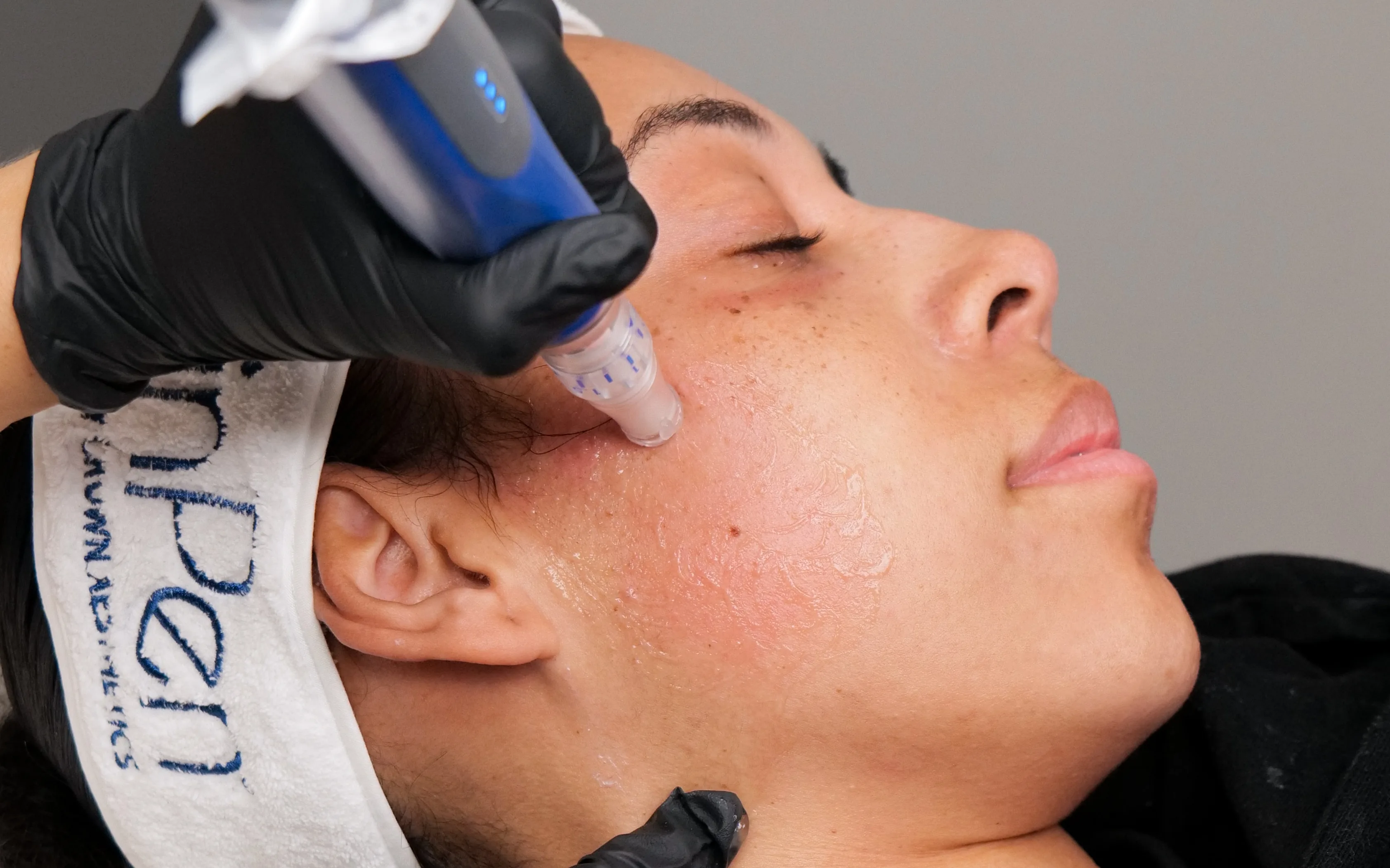SkinPen microneedling with ZO serums in Ponte Vedra — close-up