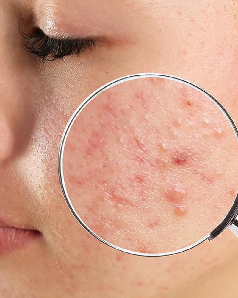 How to get rid of your acne scars