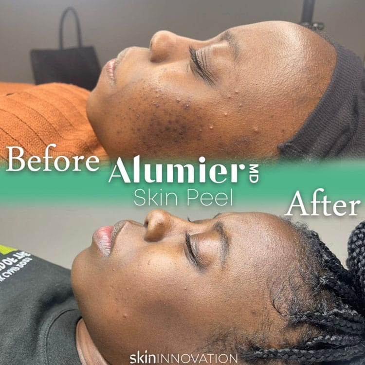 Alumier MD Skin Peel Acne Skin Peel