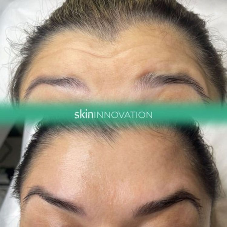 Anti-Wrinkle treatment Anti-Wrinkle injections in Brentwood