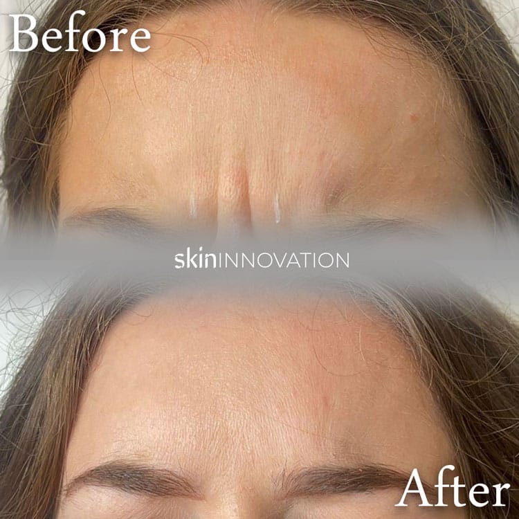 Anti-Wrinkle treatment Before & After Image Anti-Wrinkle treatment in Brentwood
