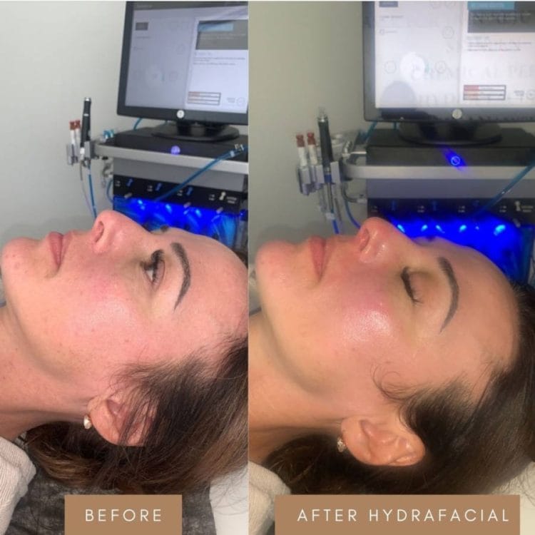 hydrafacial-before-and-after-4