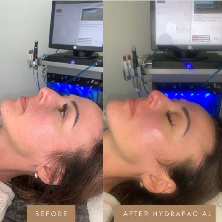 Hydrafacial Before and After 4 hydrafacial-before-and-after-4