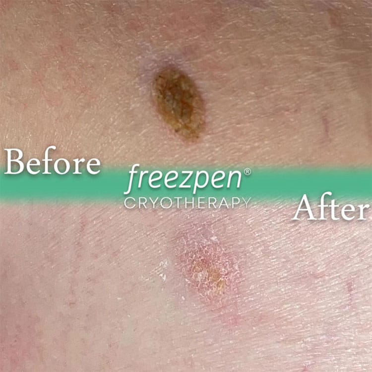 Freezpen wart removal, before and after