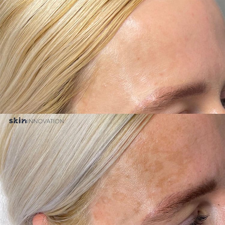 Pigmentation Removal Before and After