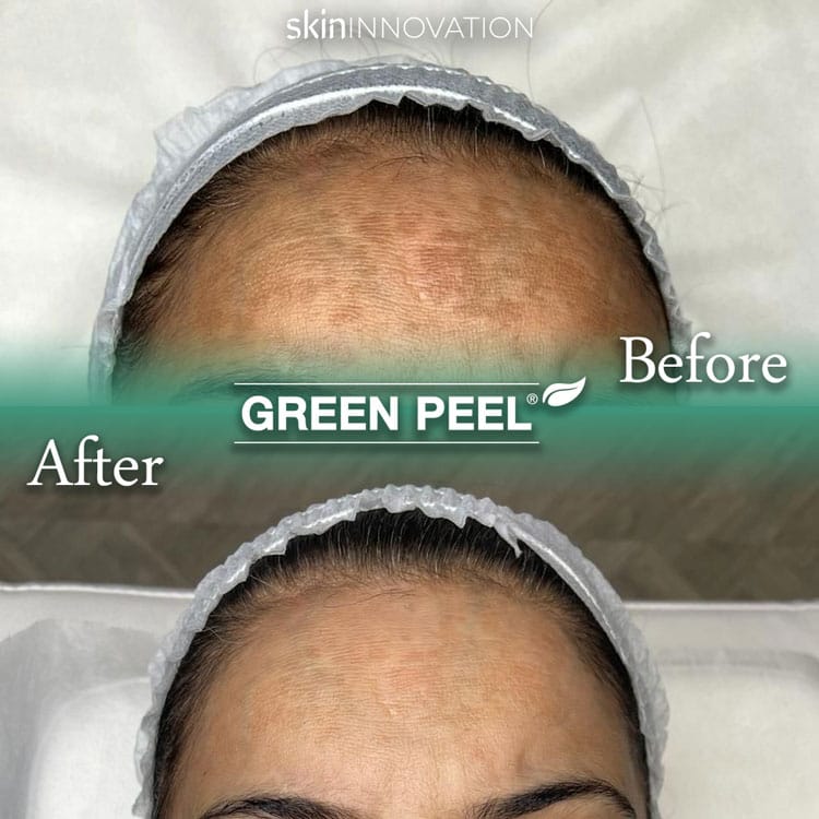 Herbal Peel Pigmentation Before and After