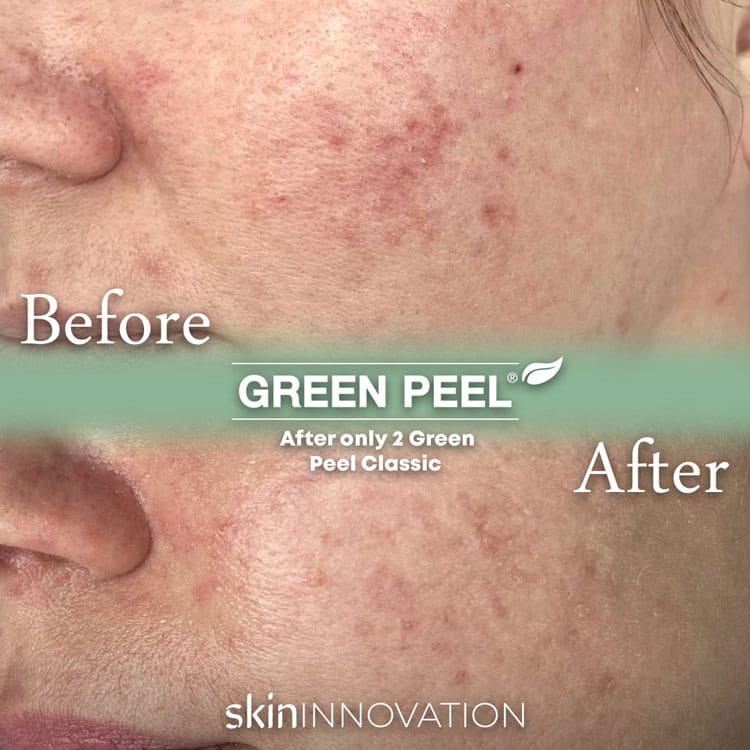 Green Peel Acne before and after