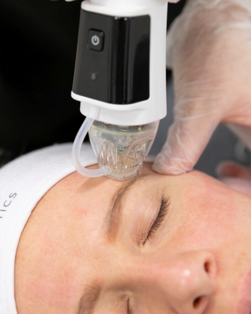 RF Microneedling