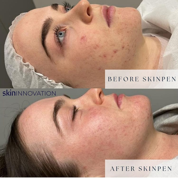 Before and after Microneedling treatment