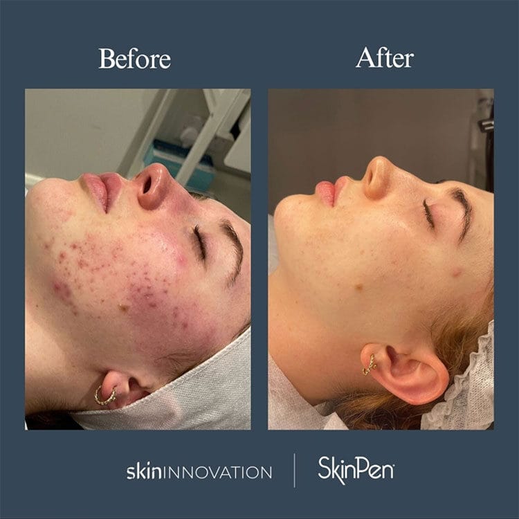 Microneedling before and after results